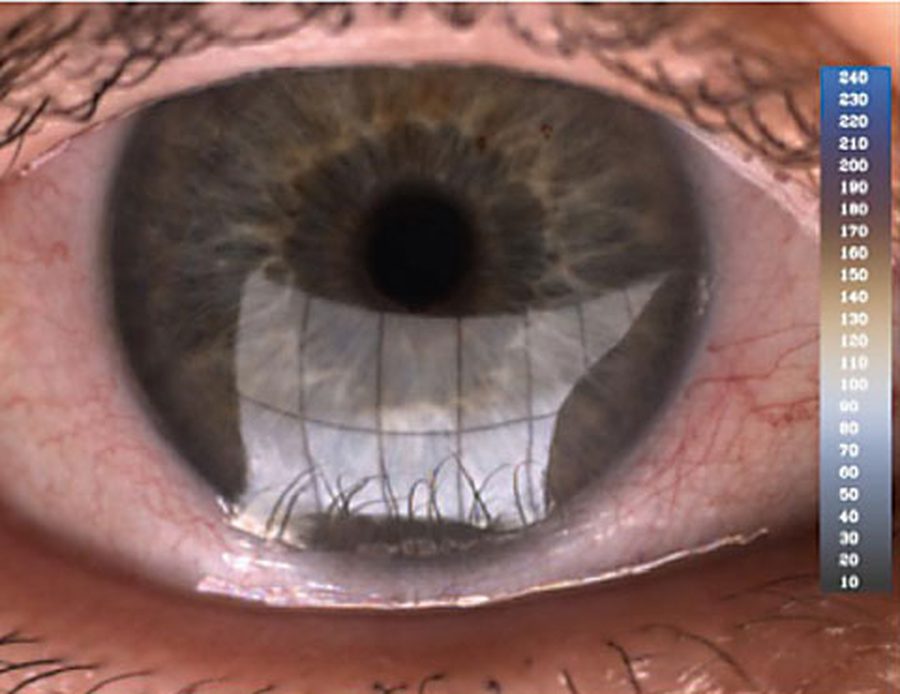 Clinical assessment showing dry eye evaluation with diagnostic imaging