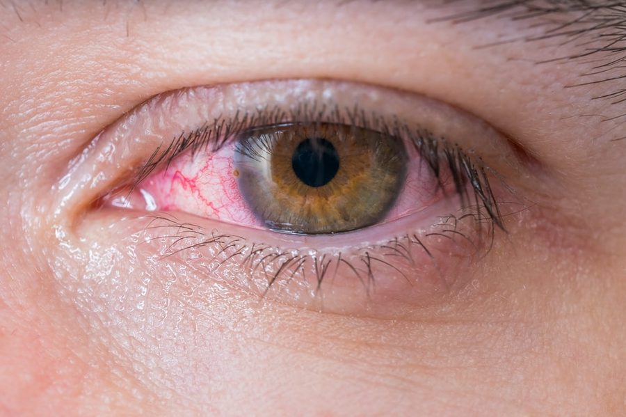 Close-up of irritated red eye — clinical sign of dry eye disease