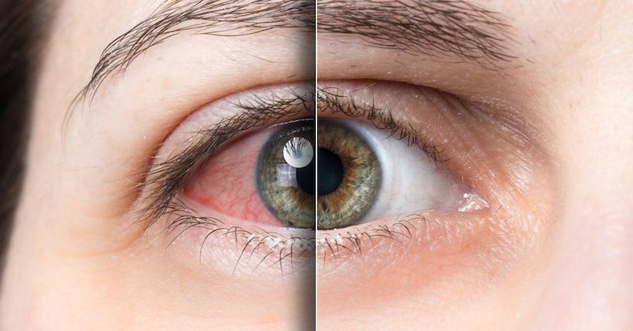 Dry eye and light sensitivity — comparison of healthy vs dry eye surface